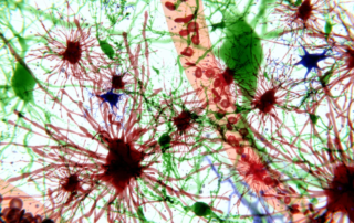 Clinical Trials Begin for Ultra-Rare Treatment of Alexander Disease